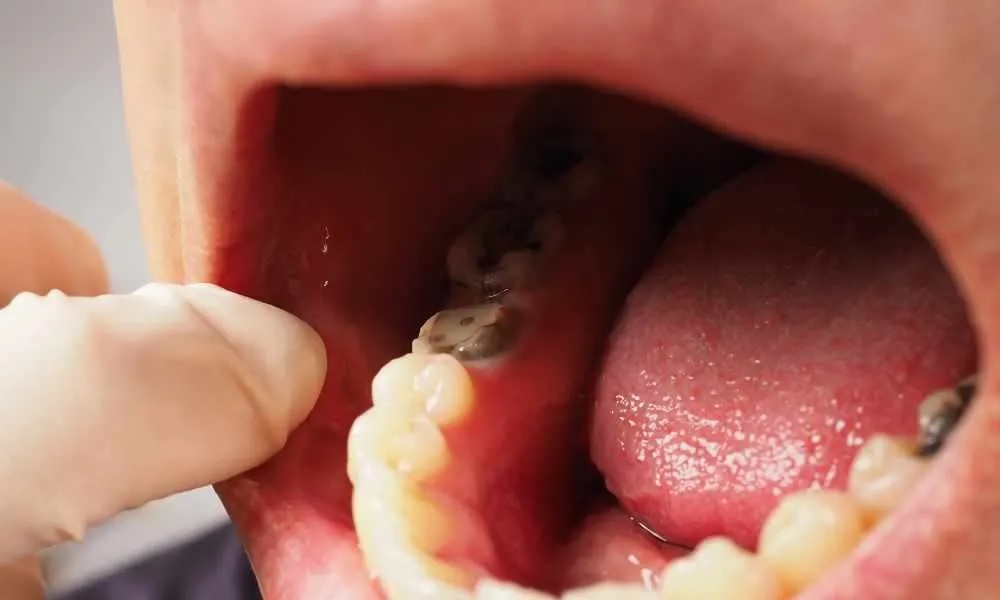 The Eco-Friendly Benefits of Choosing Composite Fillings Over Amalgam in Fishers